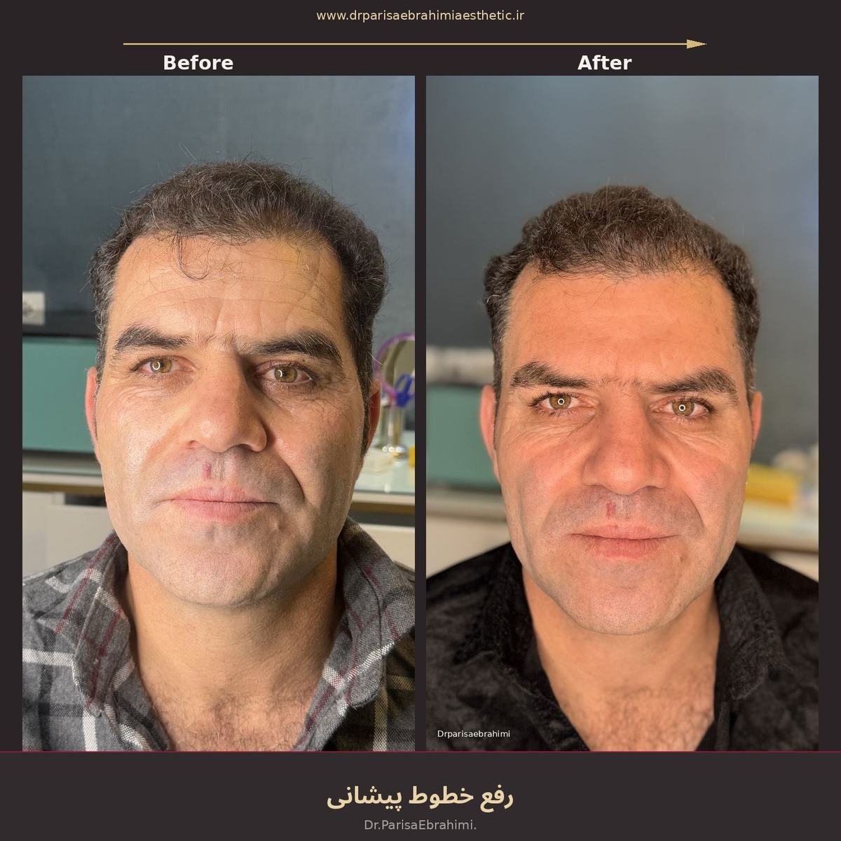 رفع خطوط پیشانی در تهران — ارزیابی خطوط پویا و ثابت پیشانی، کلینیک دکتر پریسا ابراهیمی نیاوران
