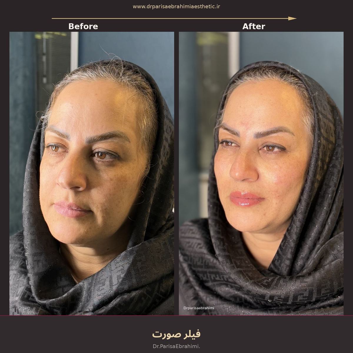 تزریق فیلر گونه و شقیقه در تهران — حجمدهی یکسوم میانی صورت، دکتر پریسا ابراهیمی نیاوران
