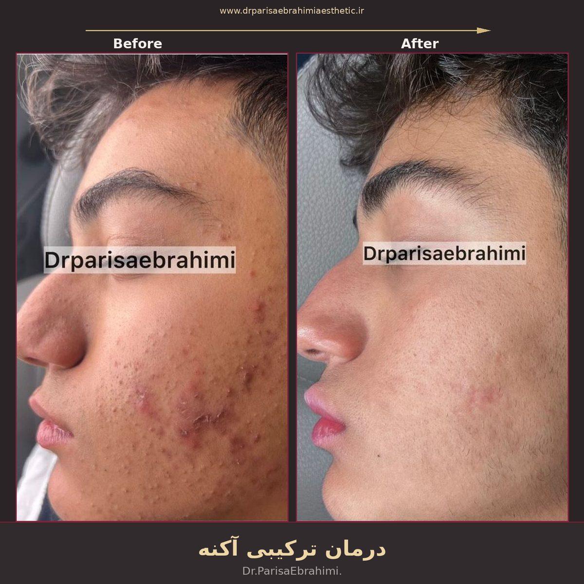 قبل و بعد درمان جوش و آکنه صورت در تهران — پروتکل ترکیبی دکتر پریسا ابراهیمی، نیاوران