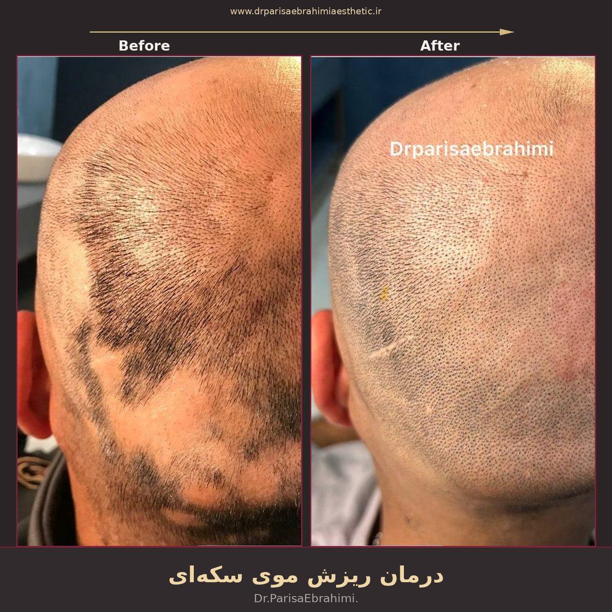 قبل و بعد درمان ریزش موی سکهای (آلوپسی آرهآتا) در تهران — دکتر پریسا ابراهیمی، نیاوران