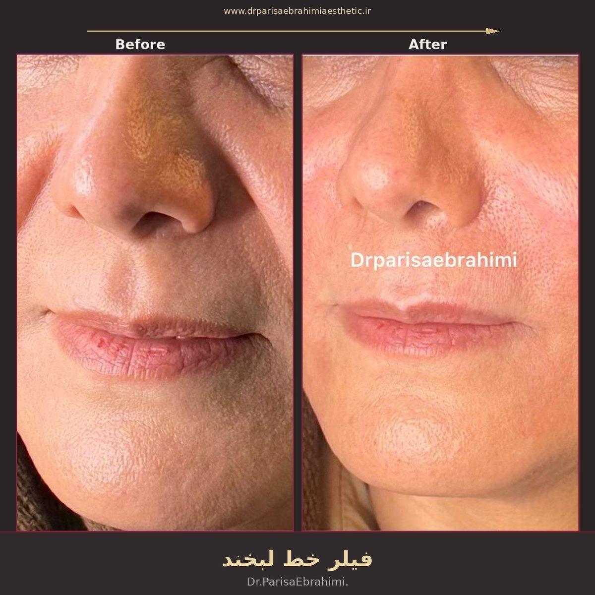 قبل و بعد تزریق فیلر خط لبخند (نازولبیال) در تهران — کلینیک دکتر پریسا ابراهیمی نیاوران