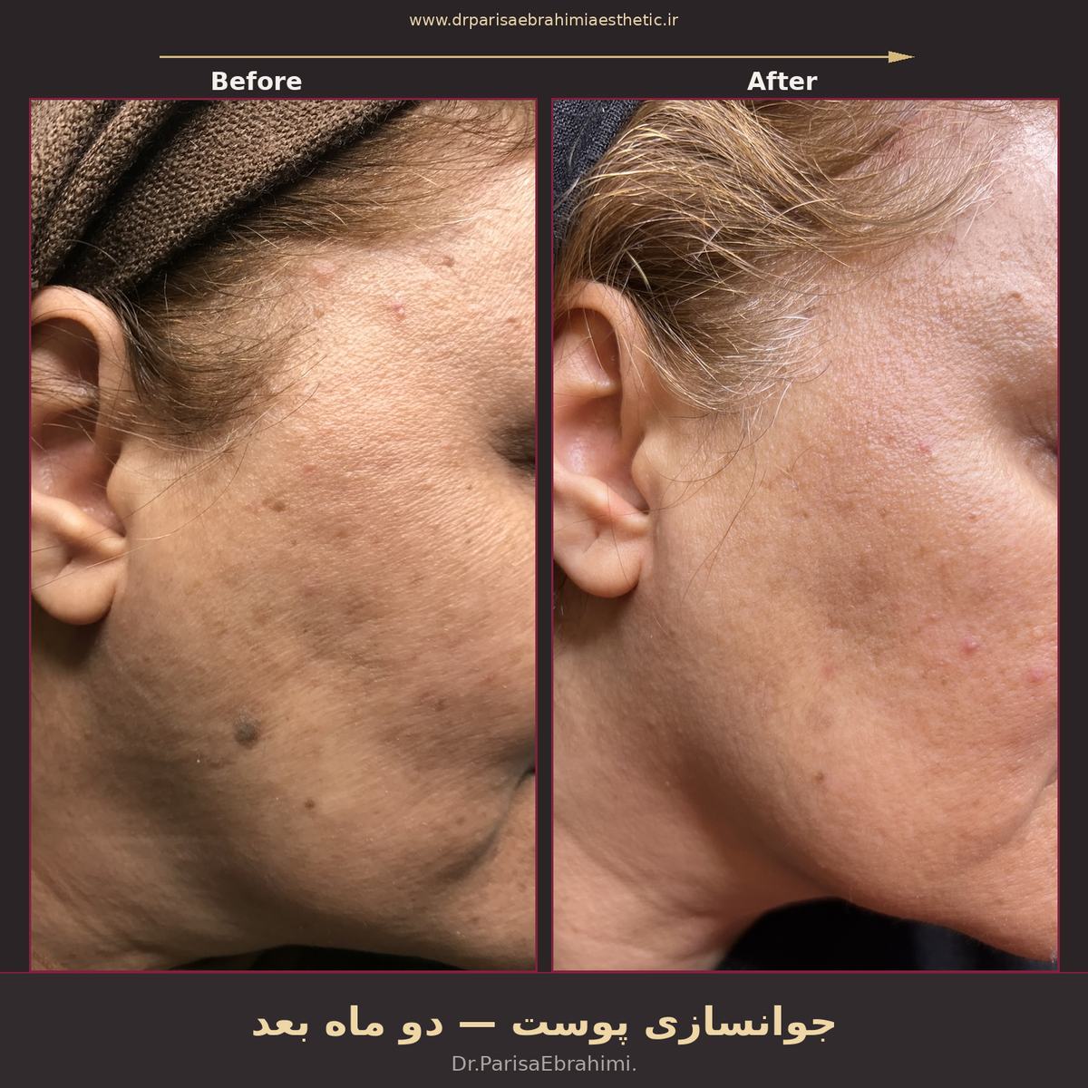 قبل و بعد جوانسازی پوست صورت در تهران — دو ماه پس از درمان، دکتر پریسا ابراهیمی نیاوران