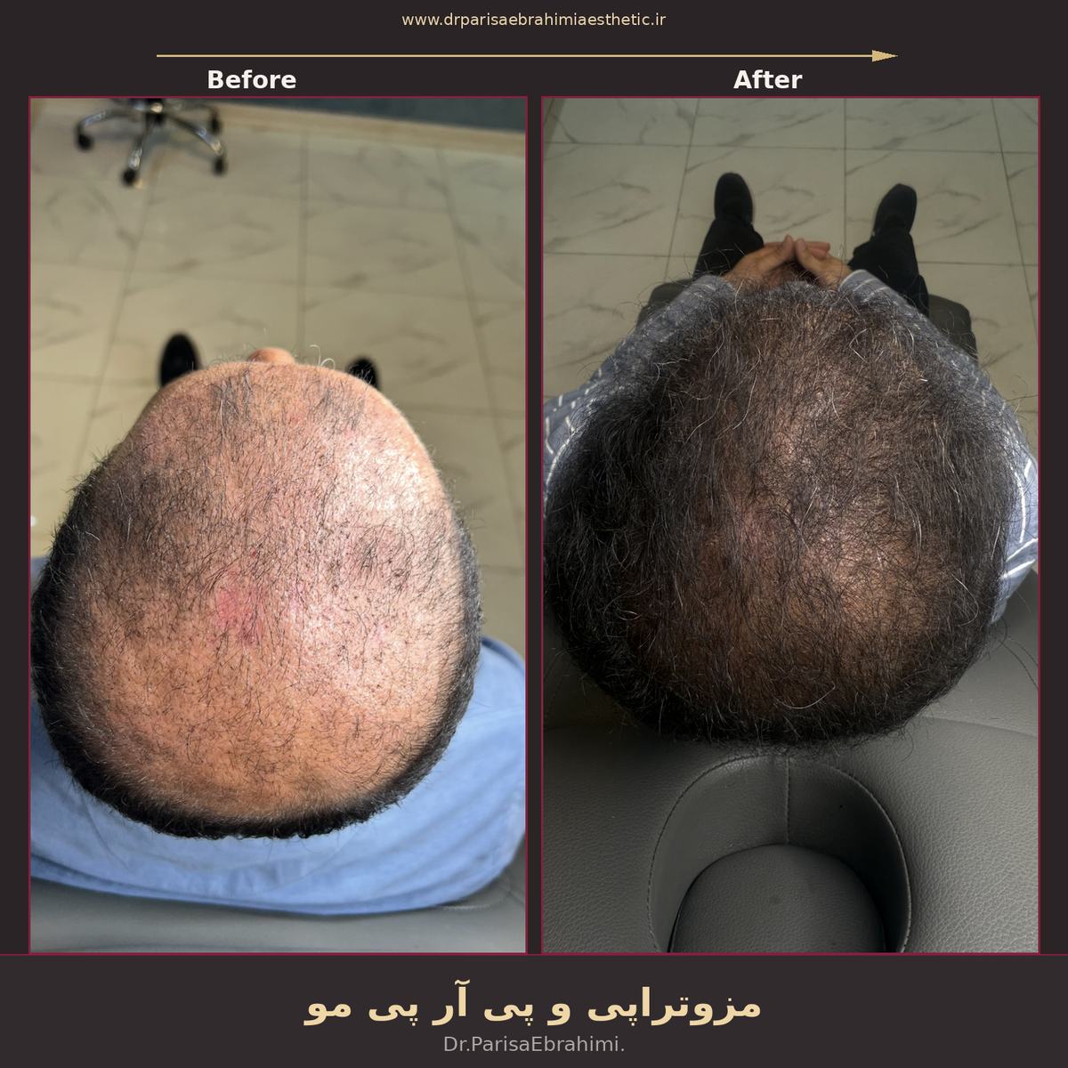 قبل و بعد مزوتراپی و PRP مو در تهران — بازگشت پوشش مو در تاج سر، دکتر پریسا ابراهیمی نیاوران