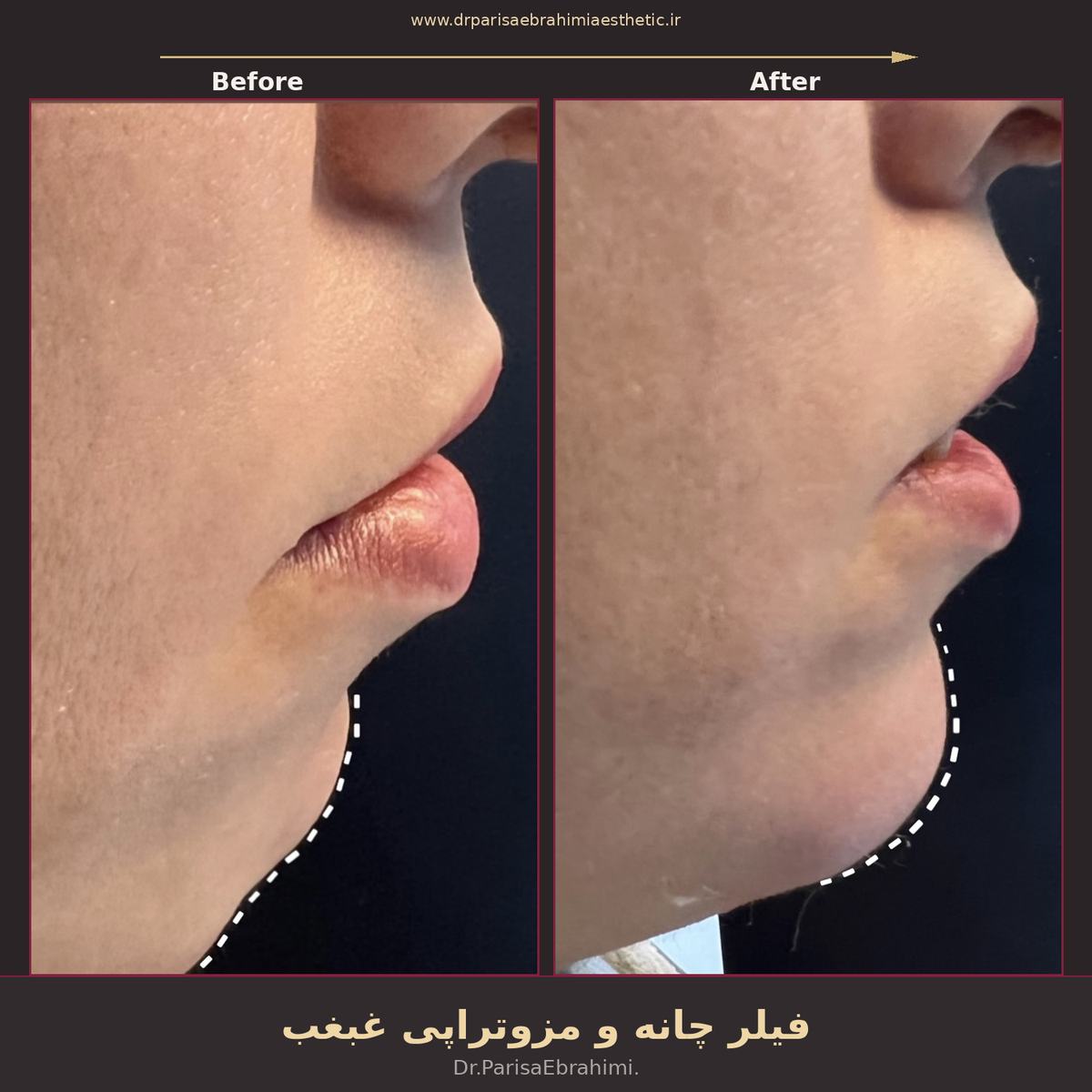 قبل و بعد تزریق فیلر چانه و مزوتراپی غبغب در تهران — تعریف خط فک، دکتر پریسا ابراهیمی نیاوران