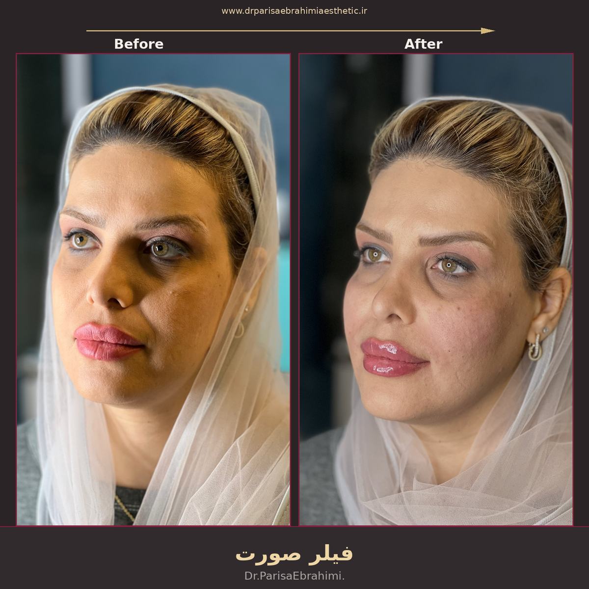 قبل و بعد تزریق فیلر فول فیس در تهران — جوانسازی کامل صورت، دکتر پریسا ابراهیمی نیاوران