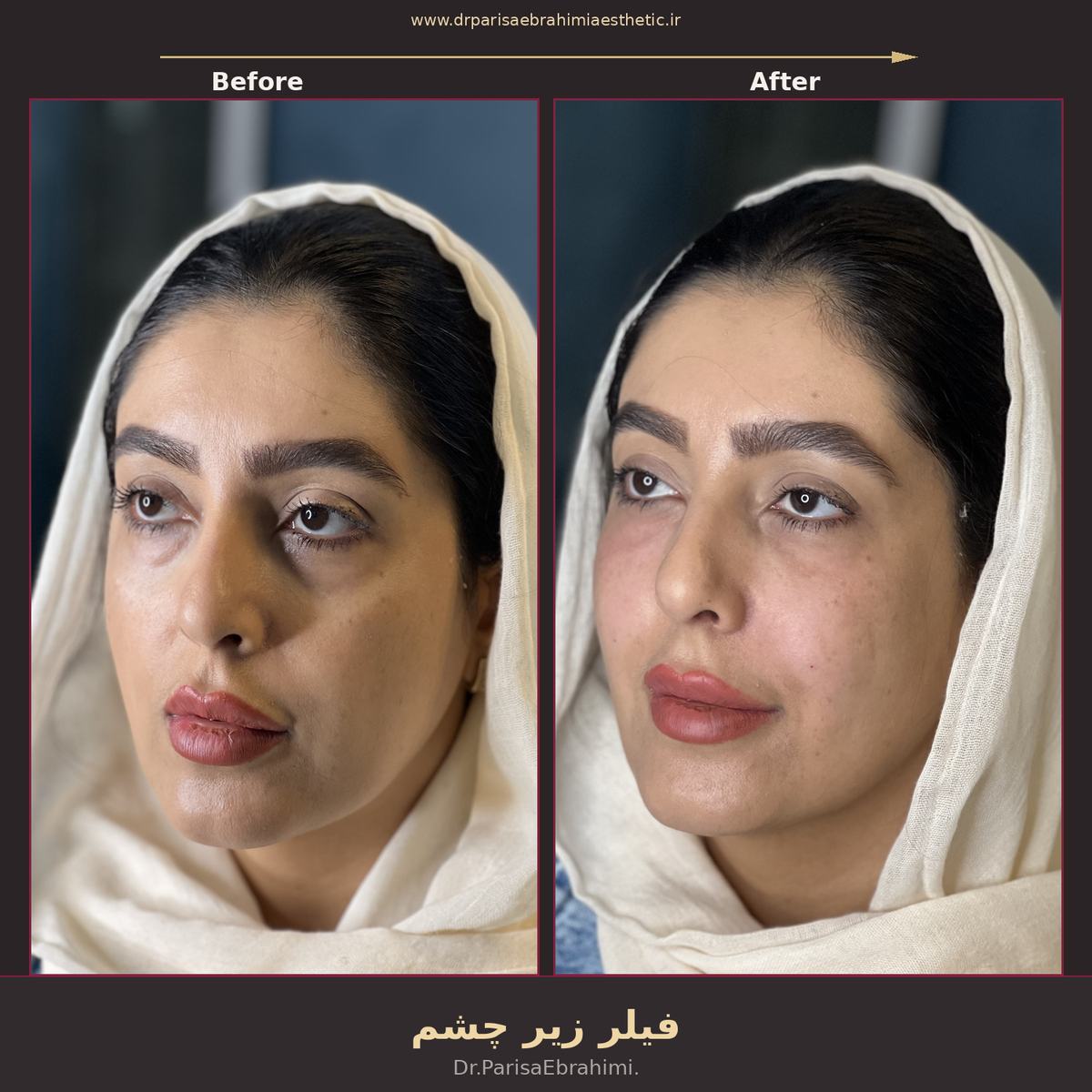 قبل و بعد تزریق فیلر زیر چشم در تهران — رفع گودی و سایه زیر چشم، دکتر پریسا ابراهیمی نیاوران