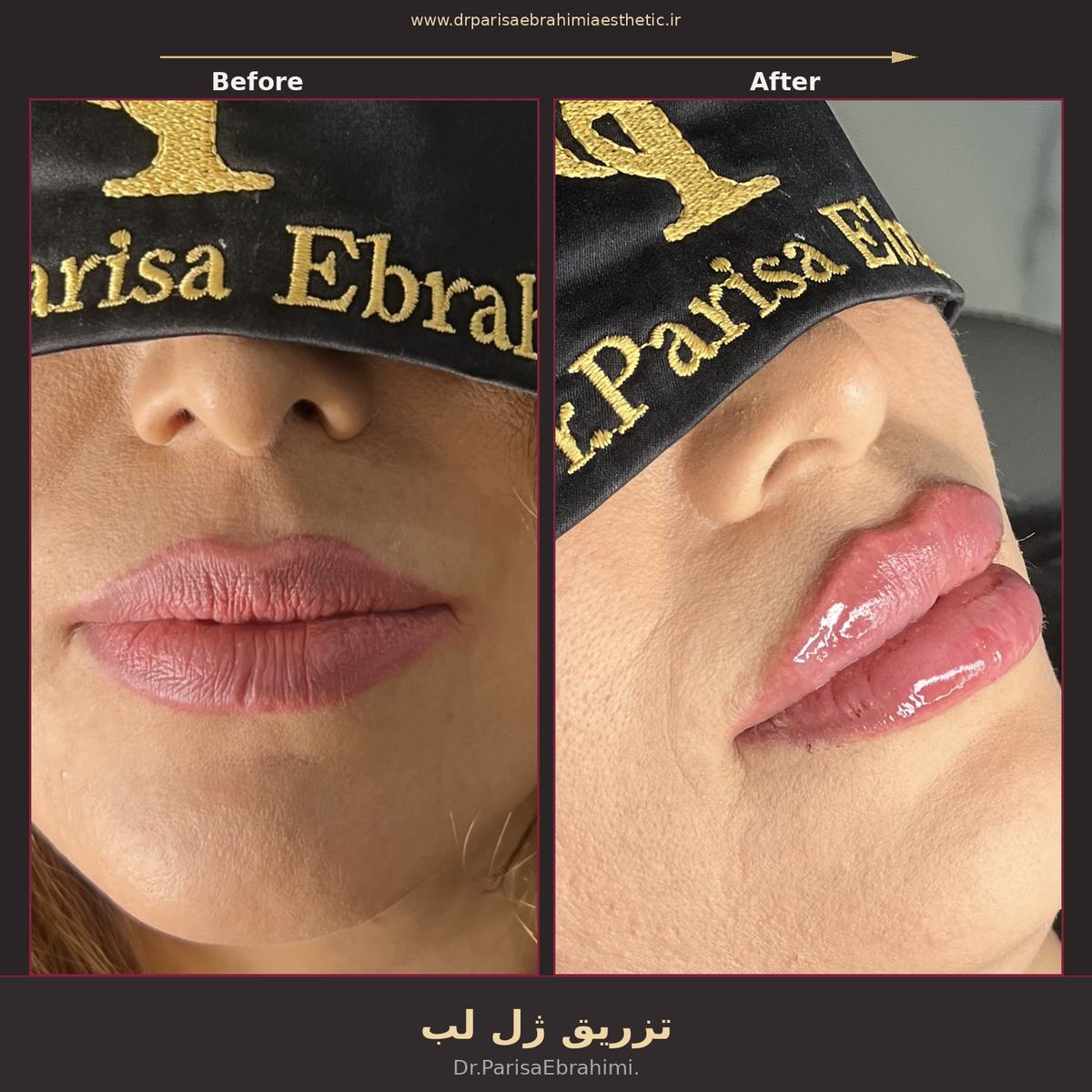 قبل و بعد تزریق ژل لب در تهران — حجمدهی و فرمدهی طبیعی لب، دکتر پریسا ابراهیمی نیاوران